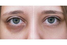 How to remove dark circles under the eyes?